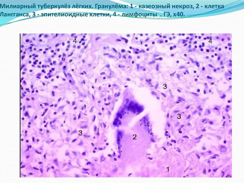Клеточный состав гранулемы. Эпителиоидно-клеточная гранулема при саркоидозе. Клетки вирхова это патанатомия. Эпителиоидно клеточная гранулема. Клеточная гранулема.