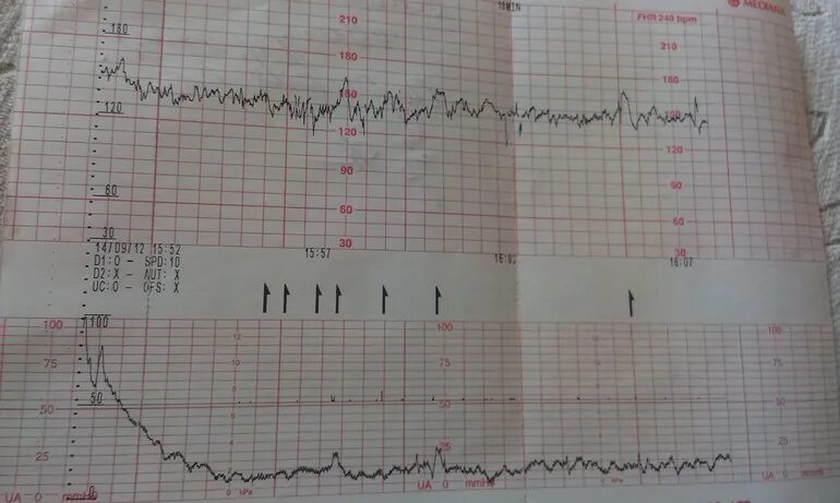 Схватки при третьей беременности. Ундулирующий ритм на КТГ. КТГ 5,1. КТГ 125 конденсатор. КТГ при беременности при гипоксии плода.
