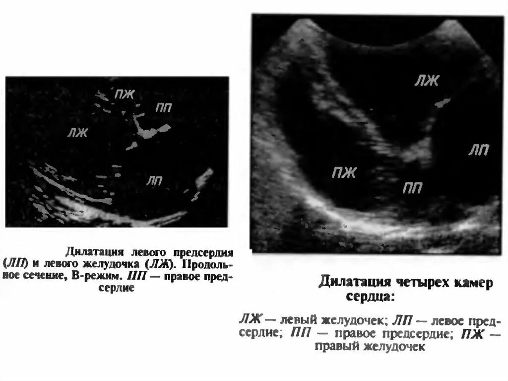 Гипертрофия правого желудочка на УЗИ. Дилатация полостей сердца ЭХОКГ. Дилатация левого желудочка ЭХОКГ. Левое предсердие ЭХОКГ. Норма правого предсердия