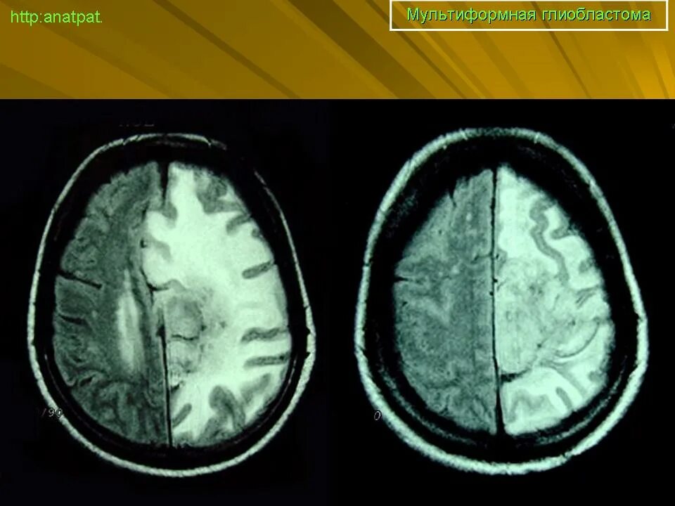 Глиобластома мозга симптомы. Мультиформная глиобластома. Мультиформная глиобластома мрт. Мультиформная глиобластома осложнения.