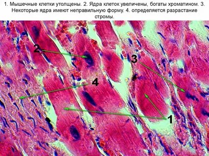 Гипертрофия препарат