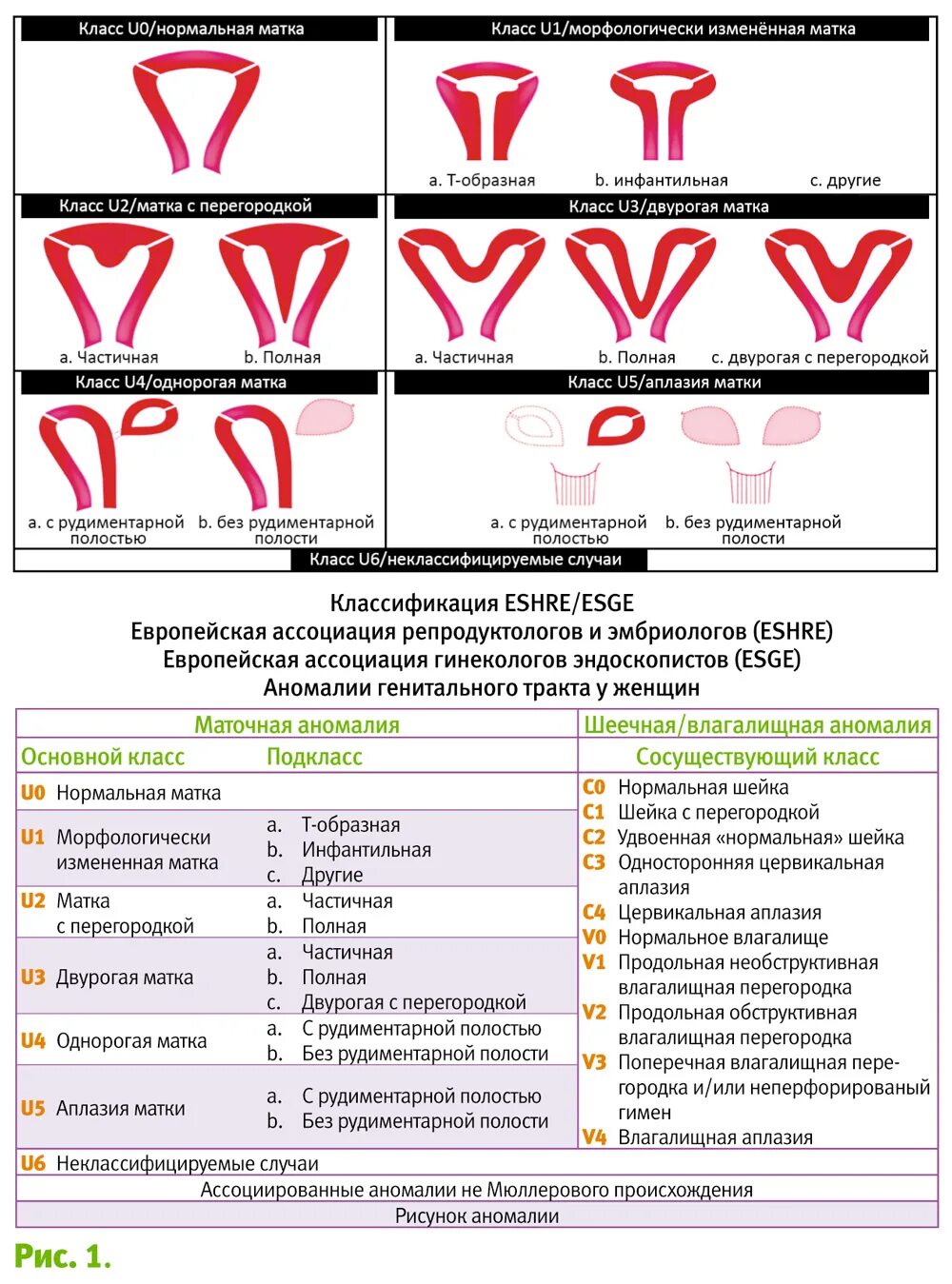 Что такое двурогая матка. Классификация пороков развития матки ASRM. Аномалии развития матки классификация. Аномалия развития матки двурогая матка. Классификация аномалий развития матки ESHRE.