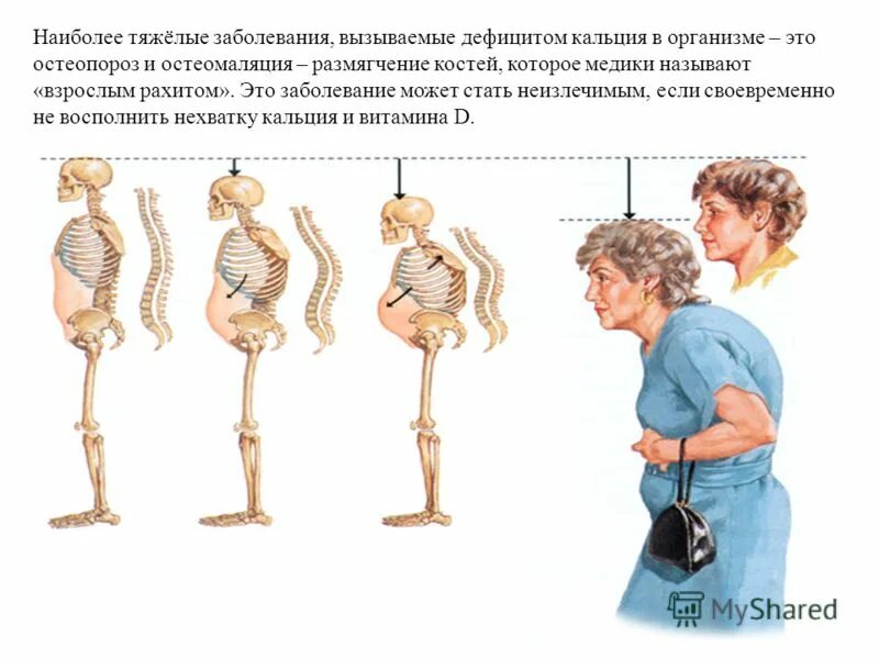 Рахит грудная клетка форма. Форма черепа у новорожденного при рахите. Рахит форма головы грудничка. Рахит остеомаляция остеопороз. Заболевание остеомаляция.