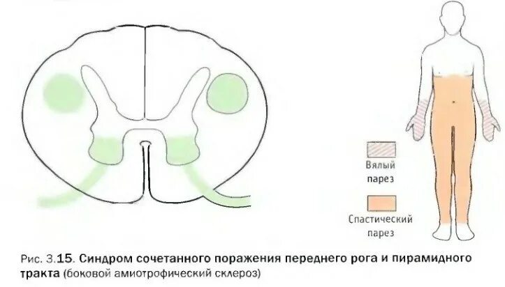 Поражение передних рогов. Синдром поражения переднего рога спинного мозга. Поражение передних Рогов спинного мозга. Симптомы поражения передних Рогов спинного мозга. Синдром поражения заднего рога спинного мозга.