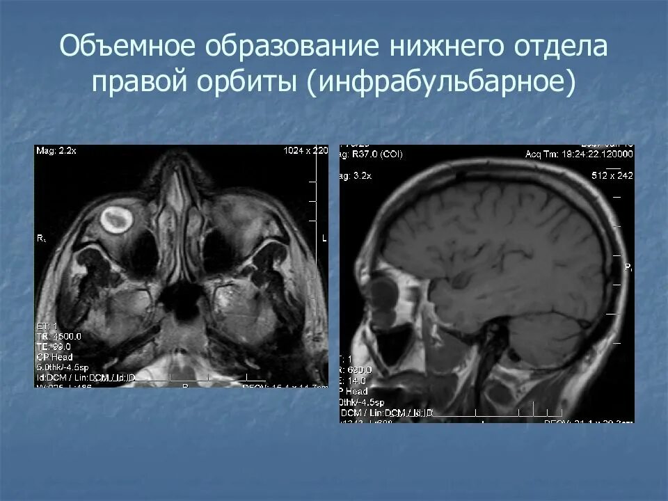 Объемное образование правой орбиты. Объемные образования орбиты на кт. Опухоли орбиты