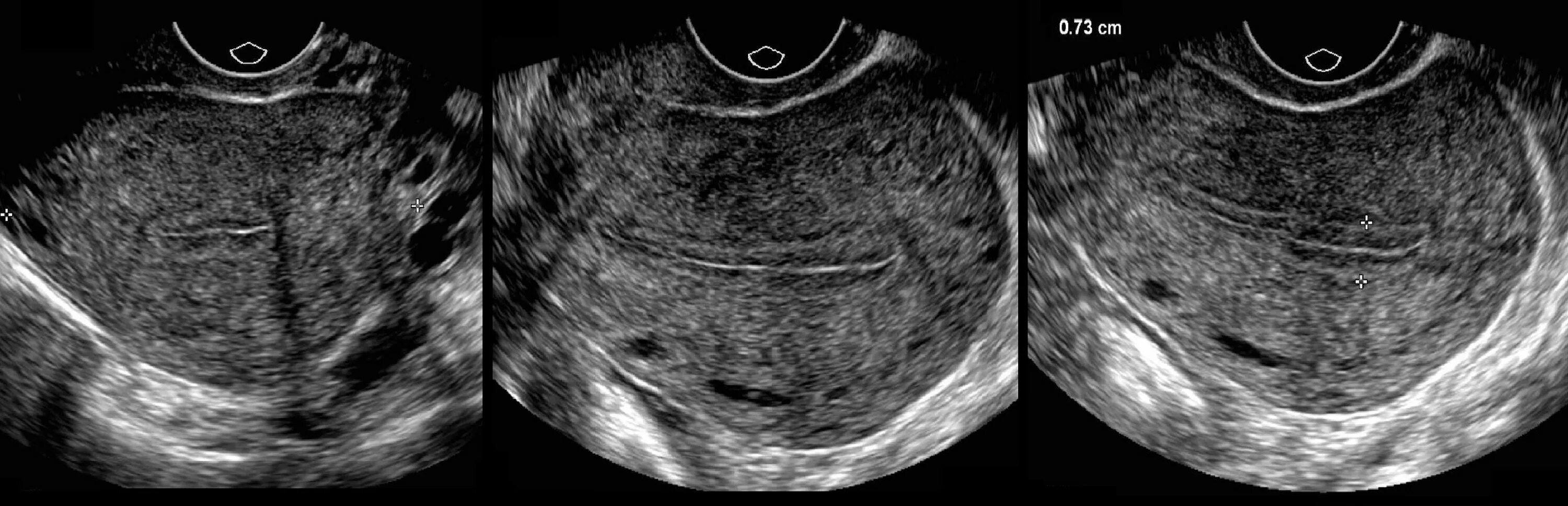 Полость матки неоднородная. Трехслойная структура эндометрия (УЗИ). УЗИ ОМТ эндометрий. УЗИ малого таза эндометрий.