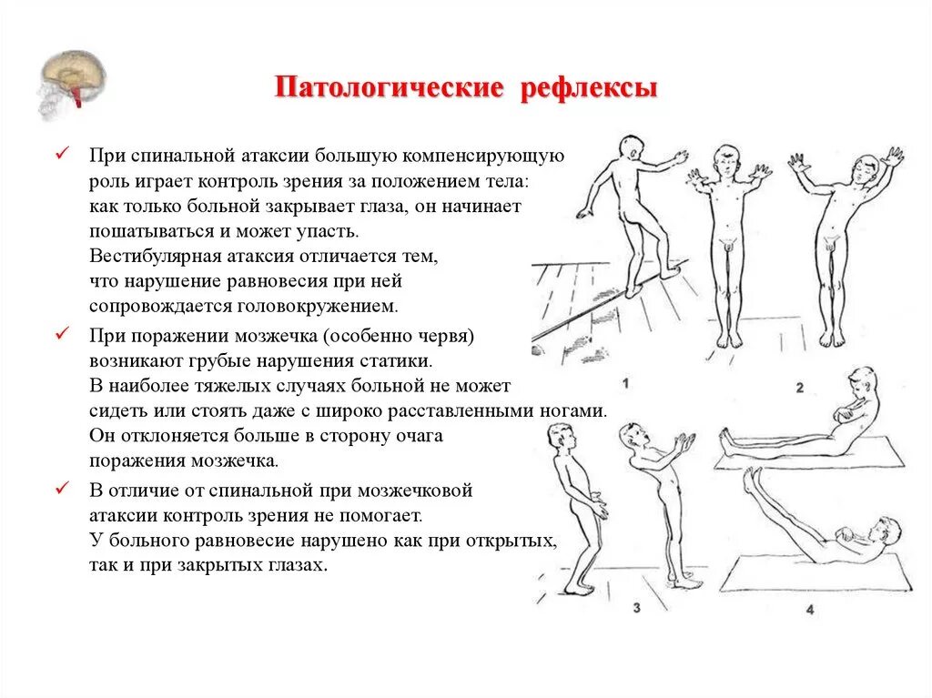 Патологические сгибательные и разгибательные рефлексы неврология. Патологические рефлексы в неврологии при инсульте. Патологические кистевые сгибательные рефлексы. Патологические рефлексы симптом Бабинского.