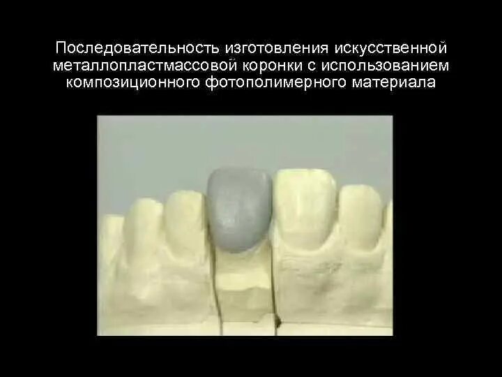 Металлопластмассовые коронки этапы изготовления. Клинико лабораторные этапы металлопластмассовой коронки. Технология изготовления металлопластмассовой коронки. Этапы изготовления металлопластмассовой коронки. Металлопластмассовые коронки этапы изготовления.