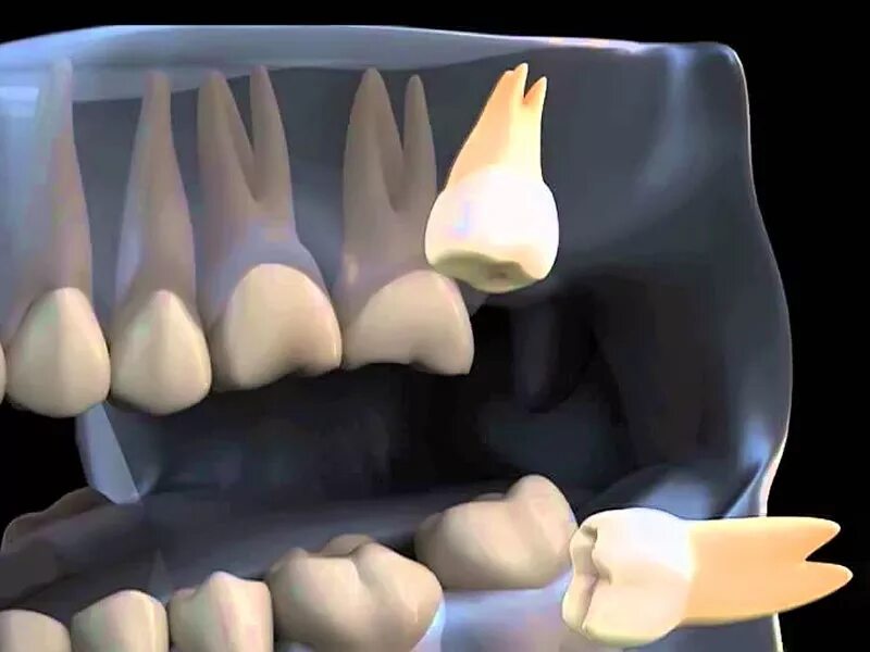 Зуб 8 нижний. Ретинированный зуб мудрости. Ретинированного зуба и дистопированного зуба.