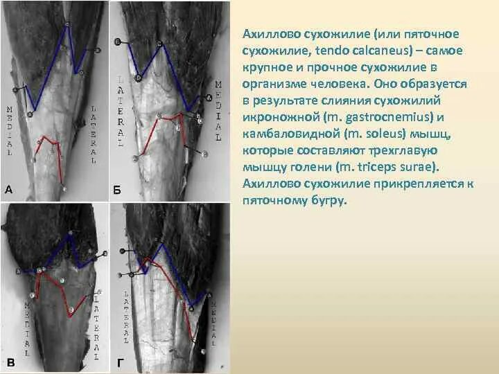 Ахиллово сухожилие иннервируется. Ахиллово сухожилие УЗИ анатомия. Ахиллово сухожилие иннервация. Ушивание ахиллова сухожилия. Топографическая анатомия сухожилий