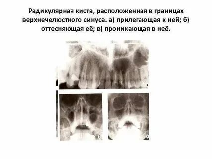 Киста правого верхней челюстной пазухи