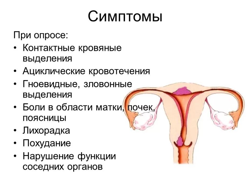 Какие симптомы при раке матки у женщин. Для аденомиоза характерно. эрозия шейки матки симптомы. полип эндометрия аденомиоз.