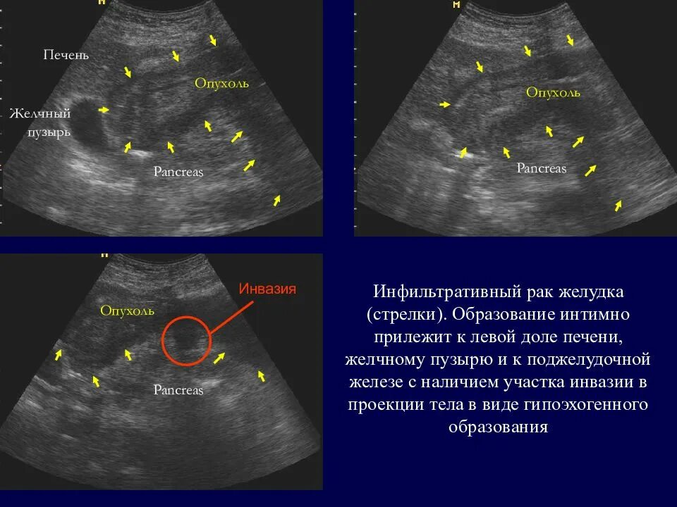 Передняя стенка желчного пузыря на УЗИ. УЗИ печени и желчного пузыря. Образование желчного пузыря на УЗИ. УЗИ органов брюшной полости утолщение стенок желчного пузыря. Узи кишечника как подготовиться