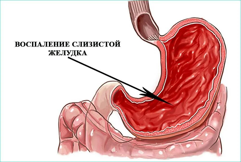 Кислотность желудка язва желудка. Гастрит слизистой оболочки желудка воспаление. Диффузный поверхностный гастрит. Воспалительные заболевания слизистой оболочки желудка. Слизистые оболочки при язвенной болезни желудка.