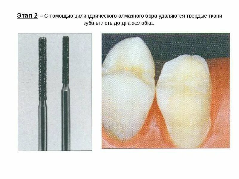 Принципы препарирования твердых тканей зуба. Препарирование премоляров под коронку. вид бора для препарирования интактной эмали коронки.