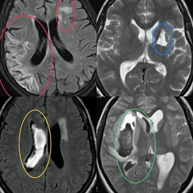 Очаги мрт мозга. Перивентрикулярный очаг головного мозга. Ишемические очаги на мрт. Очаг в мозге на мрт. Мрт головного мозга картина.