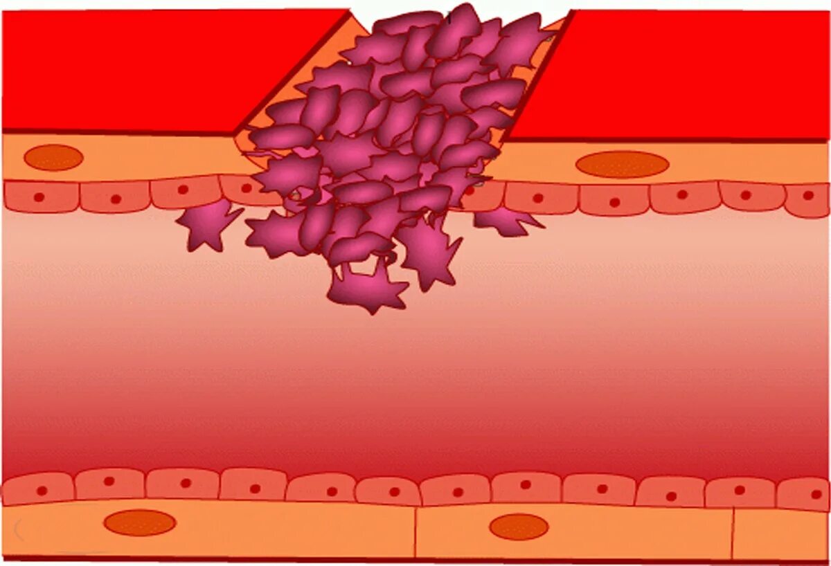 Кровяной тромб