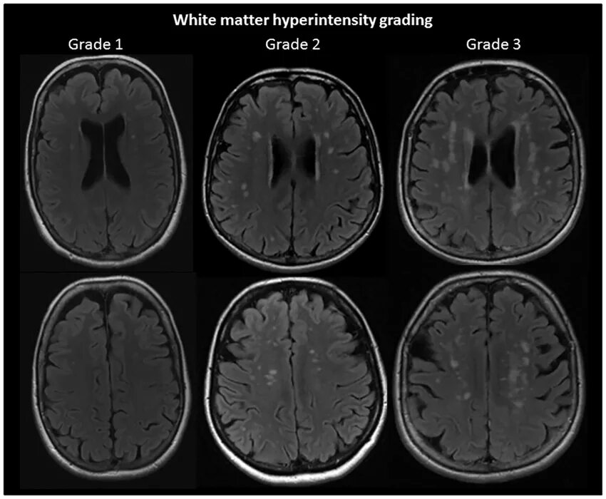 Микроангиопатия головного мозга fazekas. Лейкоареоз Fazekas 2. Fazekas III мрт. Лейкоареоз по Фазекас. Fazekas 1-2.