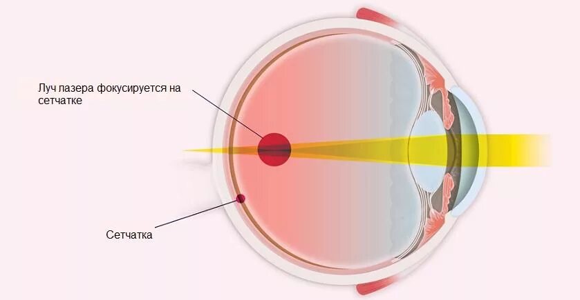 Изображение на сетчатке глаза появляется. Отслойка сетчатки лазерная коагуляция. Приваривание сетчатки лазером. Разрыв сетчатки лазерная коагуляция. Ограничительная лазеркоагуляция сетчатки.