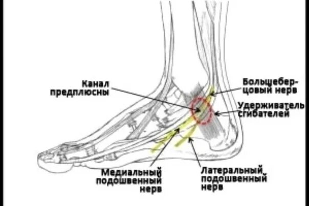 Каналы подошвы. Туннельный синдром большеберцового нерва. Лодыжковый канал топография схема. Тарзальный туннельный синдром голени. Тарзальный канал большеберцового нерва анатомия.