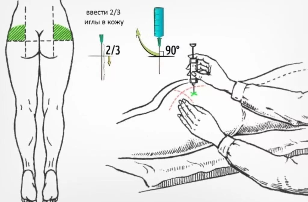 Как держать иглу. Схема введения внутримышечной инъекции. Внутримышечная инъекция в ягодицу алгоритм. Введение внутримышечной инъекции в ягодицу алгоритм. ВМ укол схема.