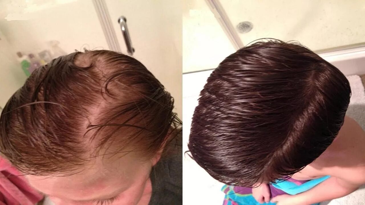 Редкий пробор. Рост волос на голове. Усиление роста волос. Рыбий жир волосы до и после.