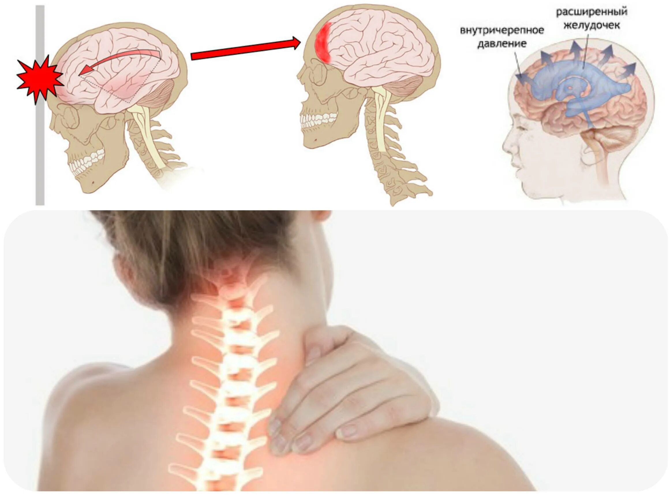 Внутричерепное давление глаза. Болит голова. Давление Черепного мозга. Давящая боль в затылке головы. Болят глаза шея голова