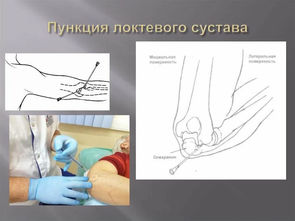 Пункция плевральной полости этапы. Пунктирование. Пункция бурсита локтевого. Плевральная пункция (торакоцентез). Пункция коленного сустава техника выполнения.