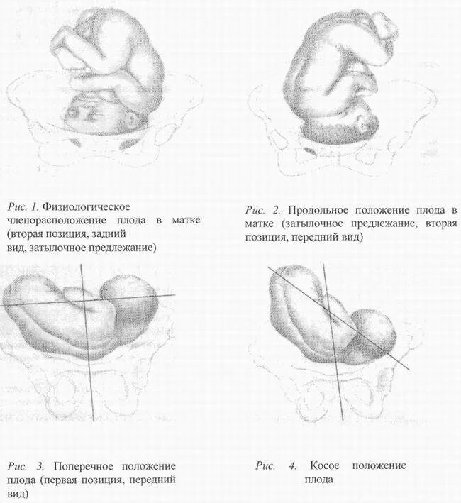 Головное предлежание 2. Предлежание положение и позиция плода. Продольное поперечное косое положение плода. Продольное положение плода 2 позиция передний вид. Продольное положение плода 1 позиция.