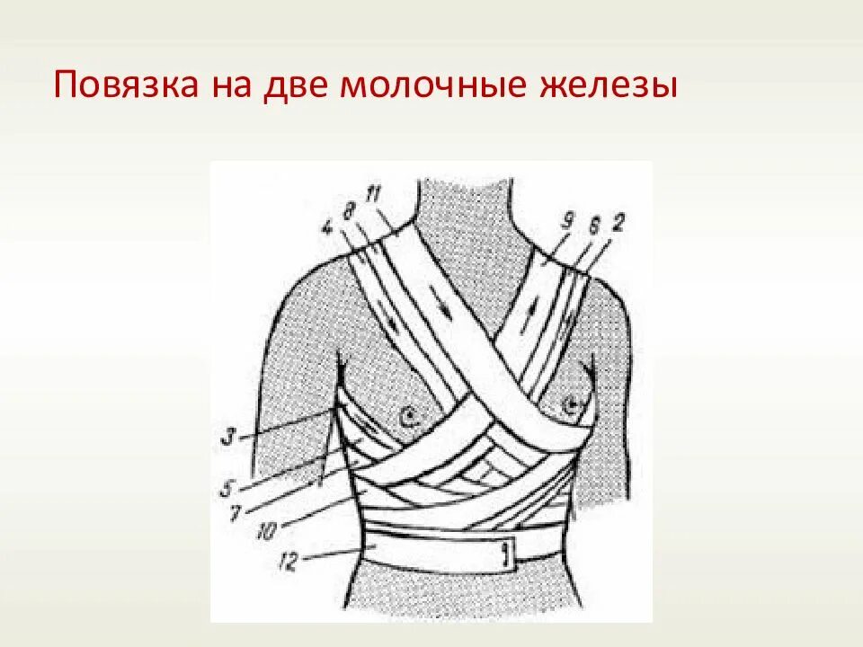 Колосовидная повязка алгоритм. Повязка вельпо техника. наложение повязки на молочную железу. повязка на руку десмургия. методика наложения повязки на молочную железу.