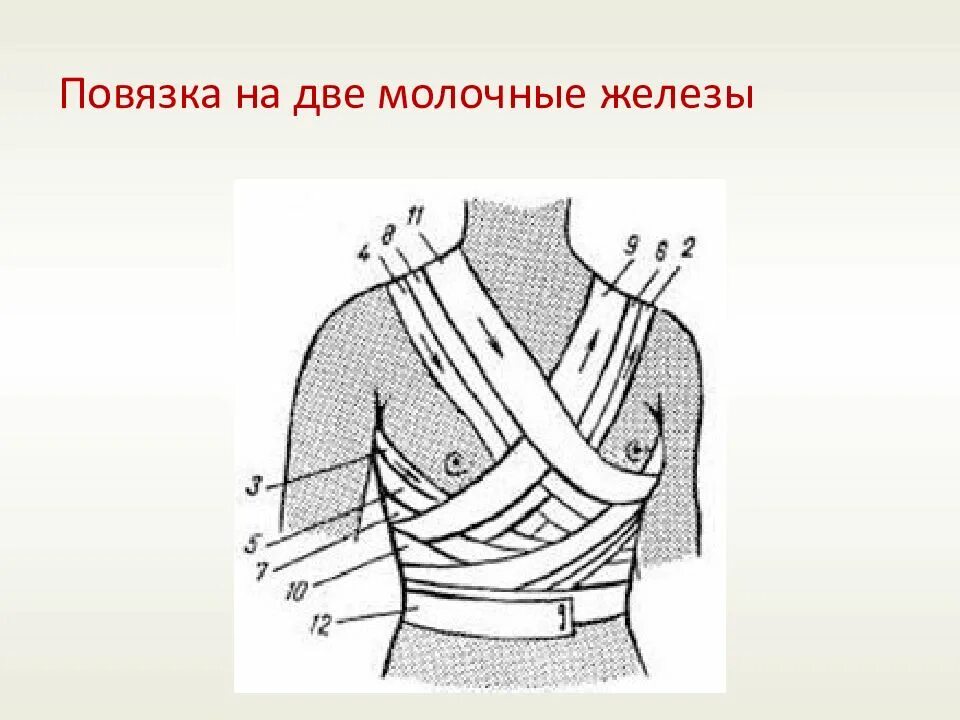 Плечевая повязка алгоритм. Повязка Вельпо техника. Наложение повязки на молочную железу. Повязка на руку десмургия. Методика наложения повязки на молочную железу.