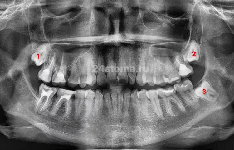 Лечат 8 зуб. Зуб восьмерка на верхней челюсти. Десна верхней челюсти зубы верхней челюсти. Зуб мудрости растет в щеку.