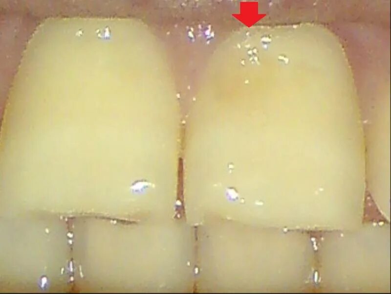 Трещина на верхних. Трещины на зубах вертикальные. Трещины на эмали передних зубов.