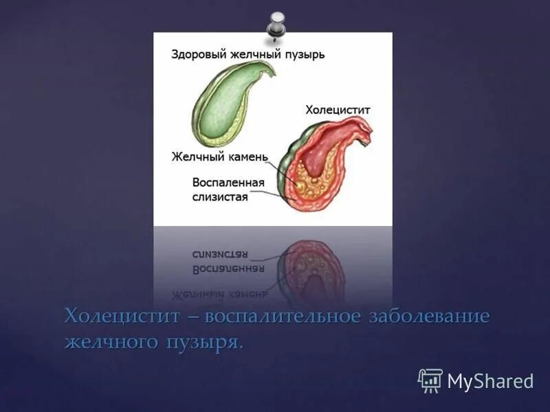 Желчный пузырь застой отзывы