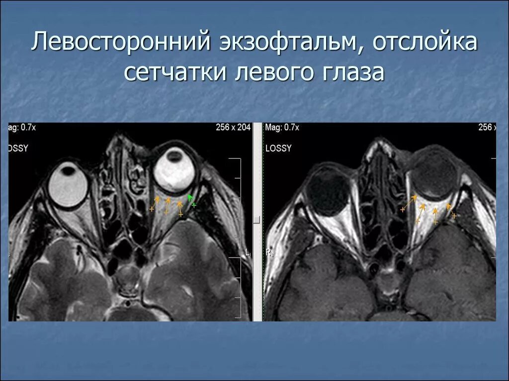 Узи глаза отслойка сетчатки. Флуоресцентная ангиография сетчатки глаза. Фтизис глазного яблока мрт. Отслойка сетчатки мрт картина. Мрт сетчатки.