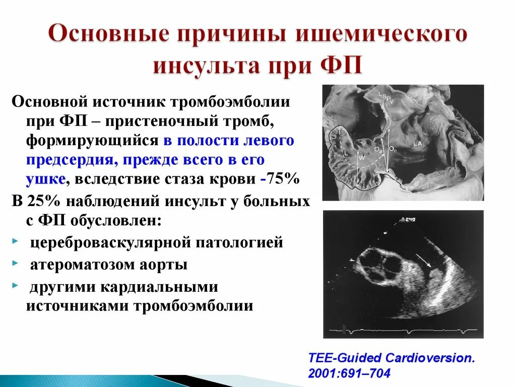 Ишемический инсульт восстановительный период. Основные причины ишемического инсульта. Ишемический инсульт причины возникновения. Осложнения ишемического инсульта. Главные причины ишемического инсульта.