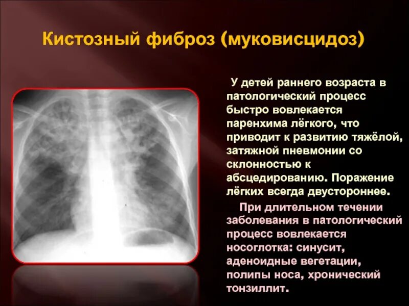 Муковисцидоз легочная форма у детей рентген. Муковисцидоз бронхолегочная форма. Фиброз легочной ткани на рентгене. Что такое кистозный фиброз лёгких. Симптомы фиброза у мужчин