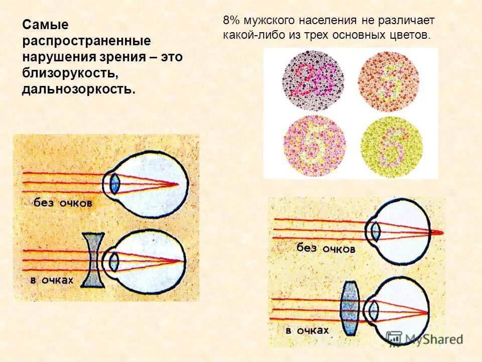 Варианты нарушения зрения. Нарушение зрения. нарушение зрения близорукость дальнозоркость. распространённые нарушения зрения. распространенные формы нарушения зрения.