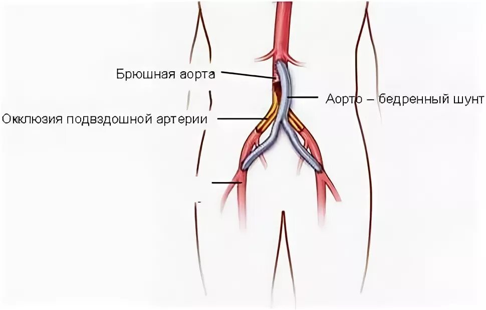 Операция на артерии нижних. Аорто бедренное бифеморальное шунтирование. Шунтирование бедренно подколенной артерии. Шунт подвздошной артерии. Аортобифеморальное шунтирование ход операции.