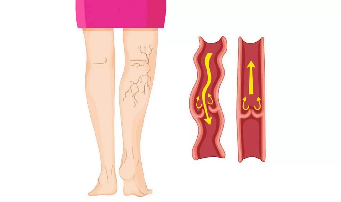 Варикозное расширение вен. Боли при варикозном расширении