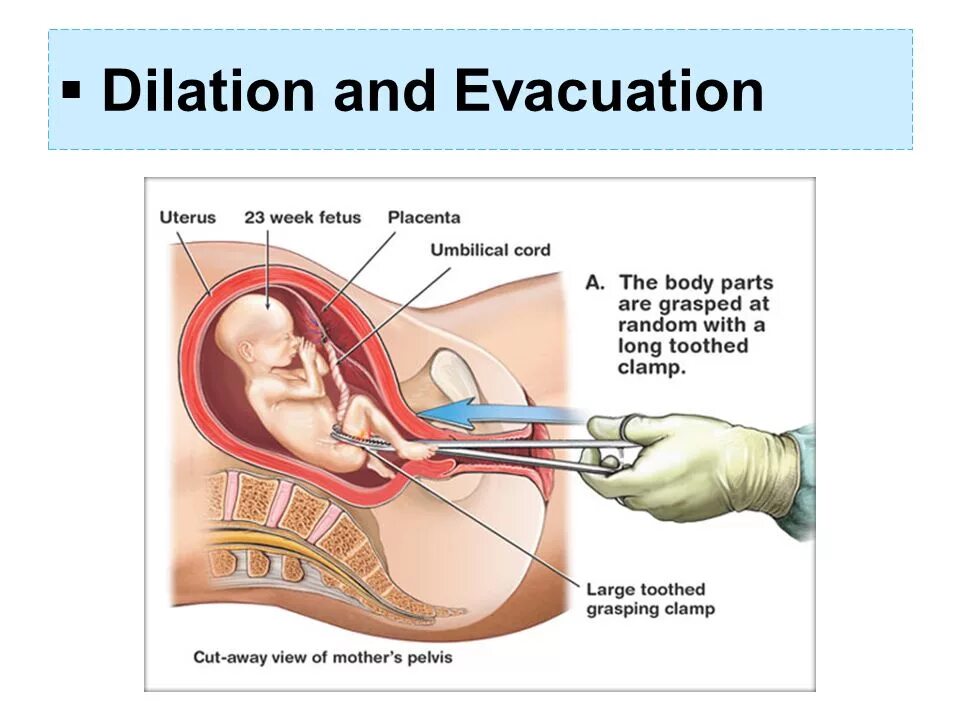 Вакуум-аспирация полости матки после медикаментозного прерывания. Вакуум аспирация аборт. Медикаментозный аборт схема. До какой недели можно делать оборот. Вакуумный аборт на 9 неделе беременности.