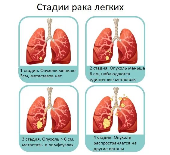 1 стадия рака как лечат. Стадии онкологии легкого. онкология легких стадии. 1 стадия онкологии легких.