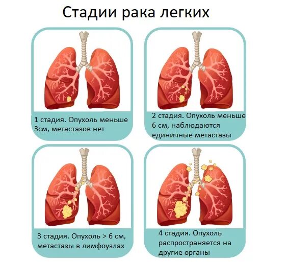 Рак легкого симптомы сколько живут. Стадии онкологии легкого. Онкология легких стадии. Степени онкологии легких.