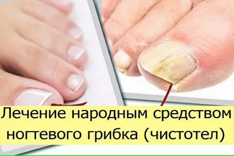 Народный метод избавиться от грибка