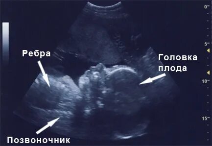 29 неделя тонус матки