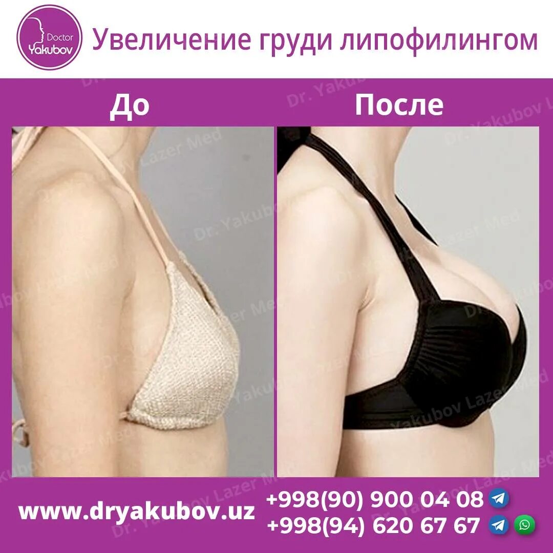 Как выглядит грудь после липофилинга Липофилинг грудных желез: что такое, этапы процедуры и реабилитация, отзывы