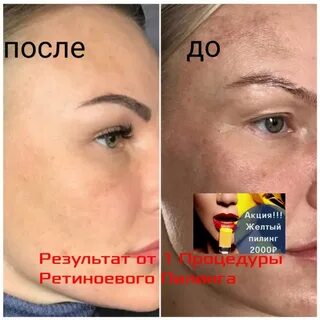 Пилинг при грудном вскармливании можно