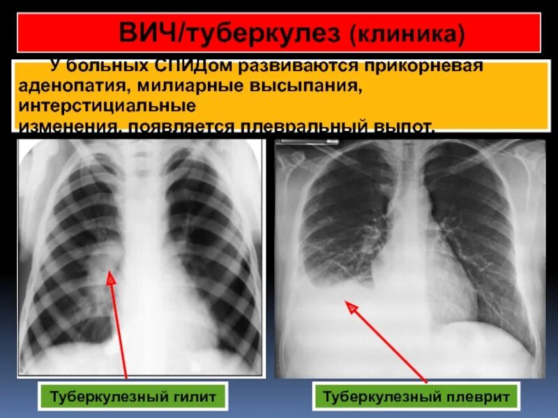 Туберкулез плеврит рентген. Туберкулез плевральный выпот. Аденопатия