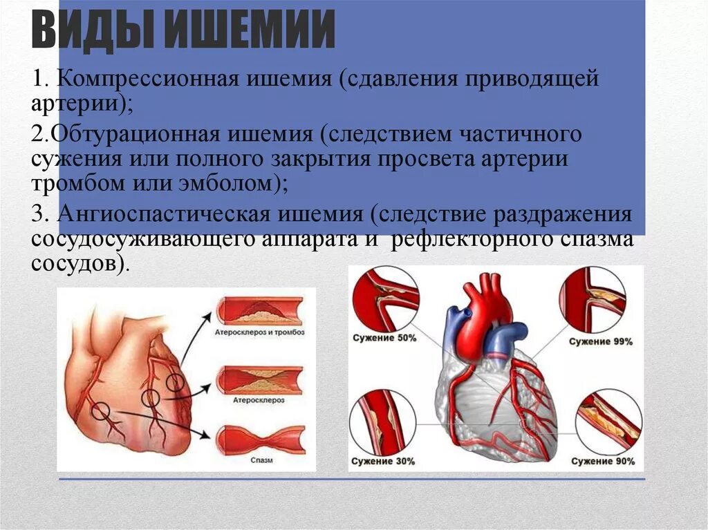 Виды ишемии. Причины ишемии. Как проявляется ишемия