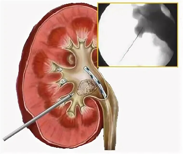 Перкутанная нефролитотрипсия. Камень в нижней чашечке почки. Кольцевидный конкремент почки. Осложнения на почки после
